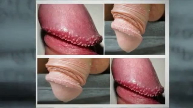 Pearly Penile Papules Removal Real Pearly Penile Papules Removal