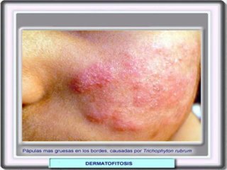 Infecciones Por Hongos No Mas Review - 100% Real & Honest