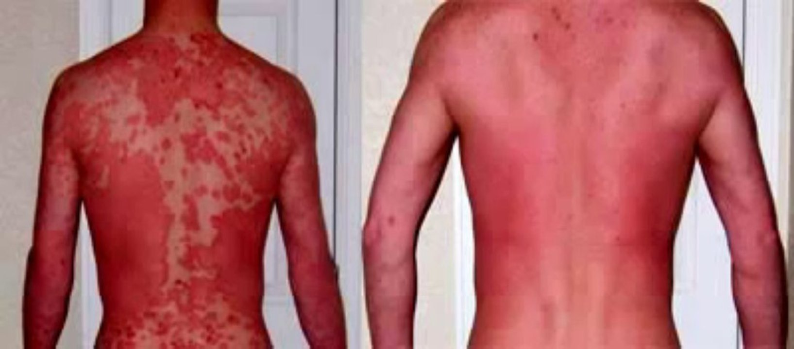 Psoriasis Free for Life pdf Download FREE