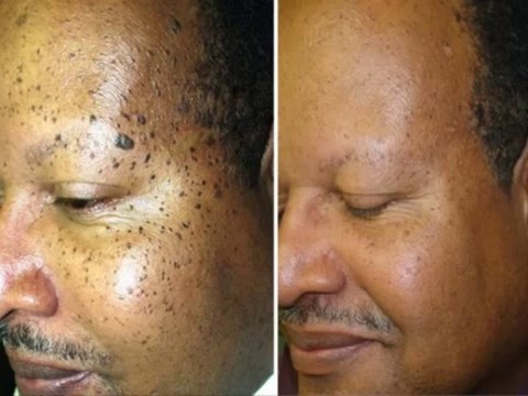 Moles warts skin tags removal cream for fast results