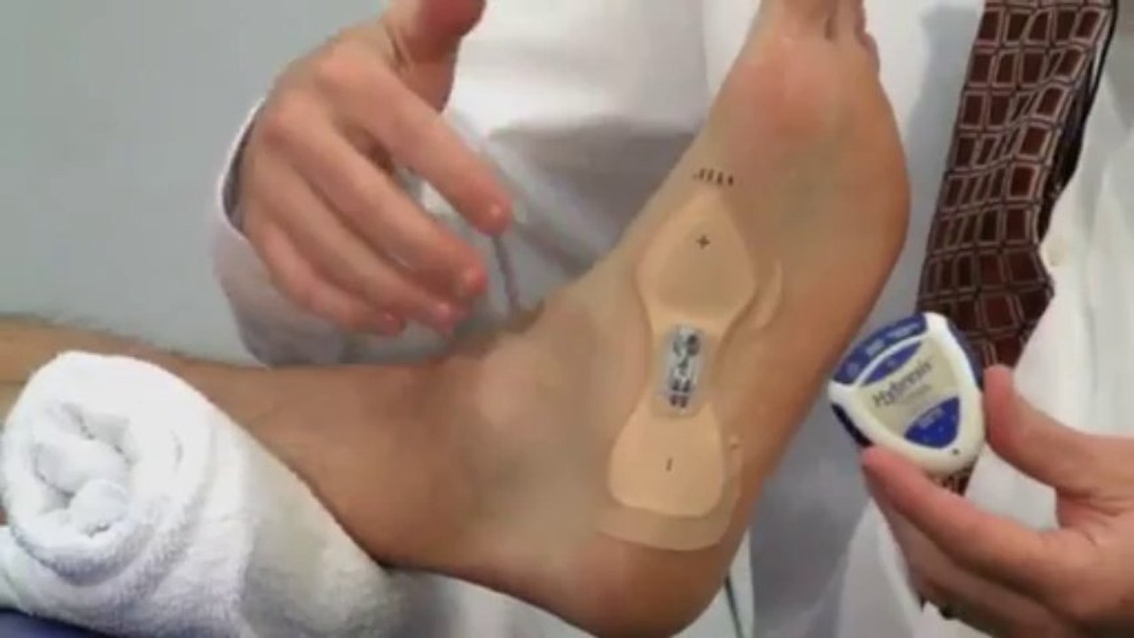 Plantar Fasciitis: Treatment by a Physical Therapist