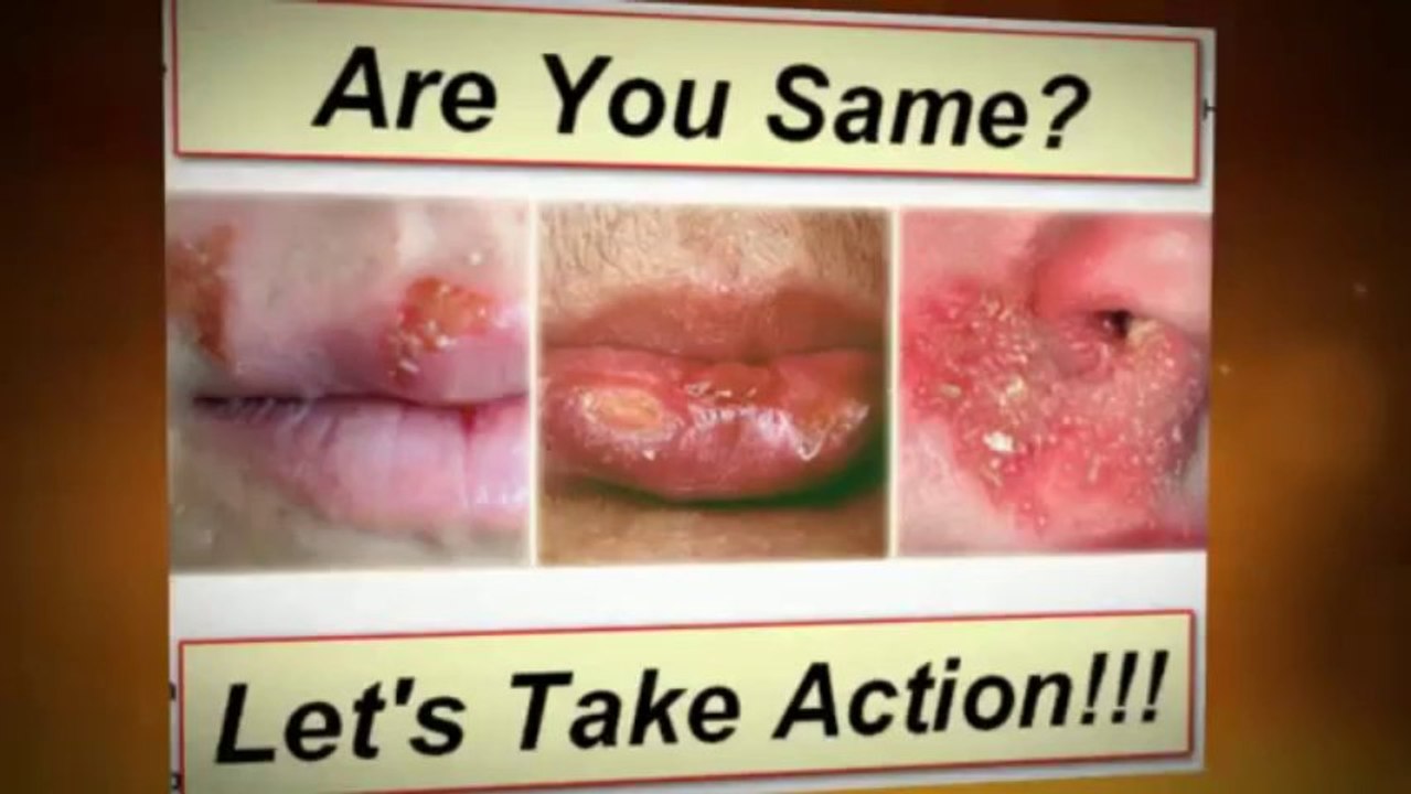 Cold Sore Free Forever PDF | Cold Sore Free Forever Free Download