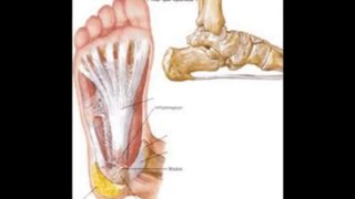 How To Cure Chronic Plantar Fasciitis
