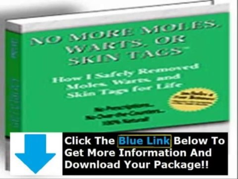 Moles Warts & Skin Tags Removal Charles Davidson + Charles Davidson Moles Warts Skin Tags Removal Review