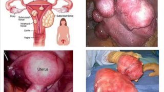 Fibroids Miracle Review - Health Review Center