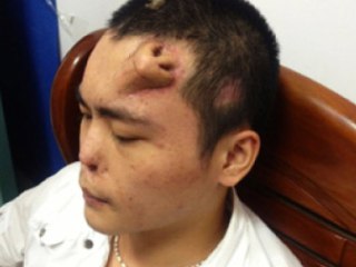 WTF Man Grows Nose On Forehead