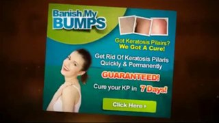 Banish My Bumps Book | Banish My Bumps Keratosis Pilaris