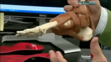 Plantar Fasciitis Treatment & Sole Custom Footbeds Review @ The InsoleStore.com