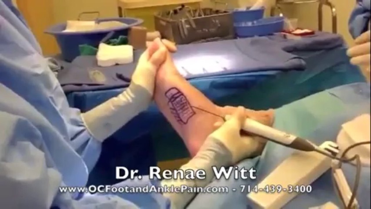 The Topaz Procedure for Treatment of Plantar Fasciitis: Dr Renae Witt D.P.M.