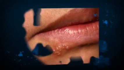 How to Get Rid of Herpes