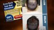 Total Hair Regrowth Review - A Hair Regrowth Review and Tips 2012