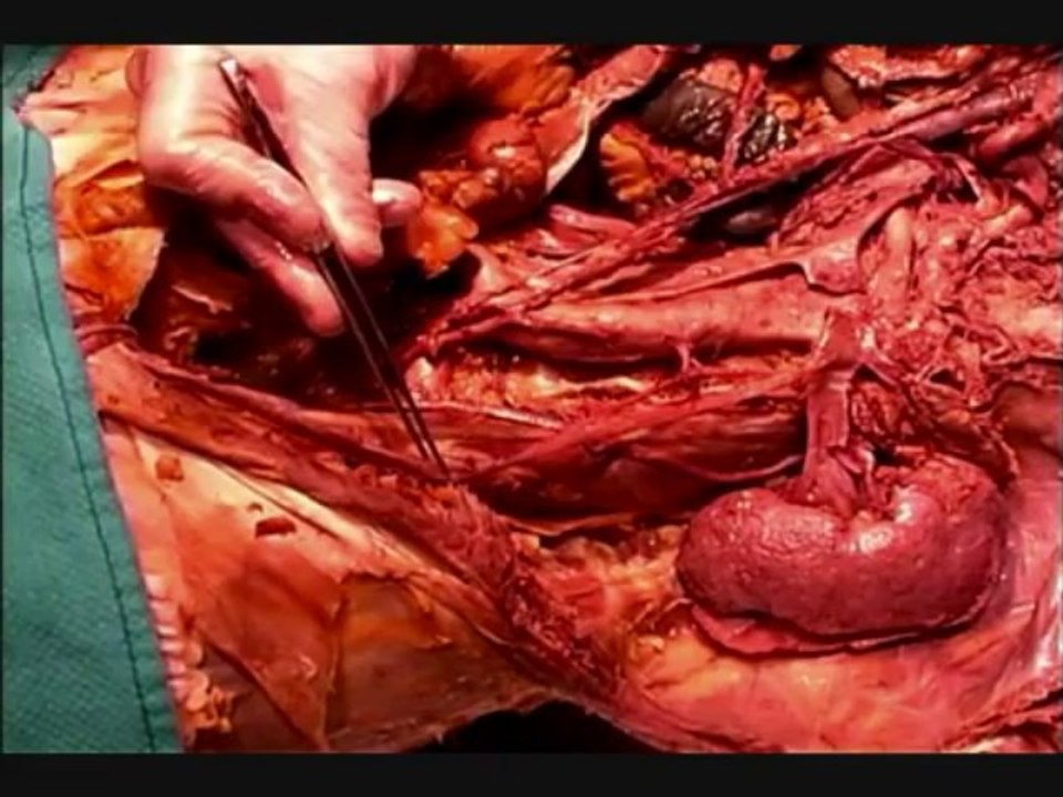 Human Anatomy Dissection 08 Abdominal Autonomics