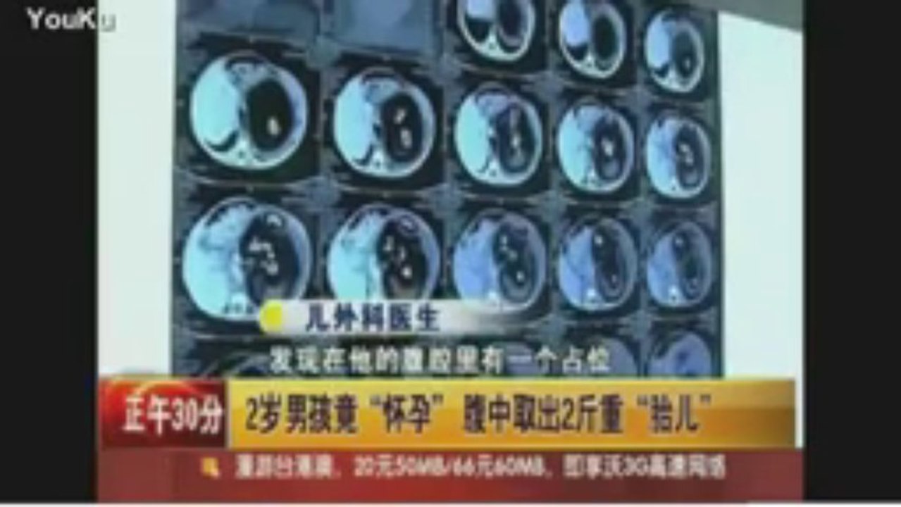 CHINE : UN GARÇON DE DEUX ANS ENCEINT, ACCOUCHE DE SON FRÈRE JUMEAU.