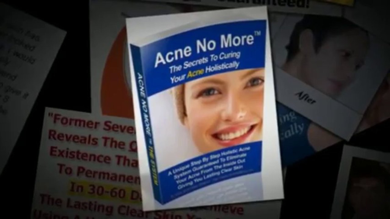 Acne No More Book Review