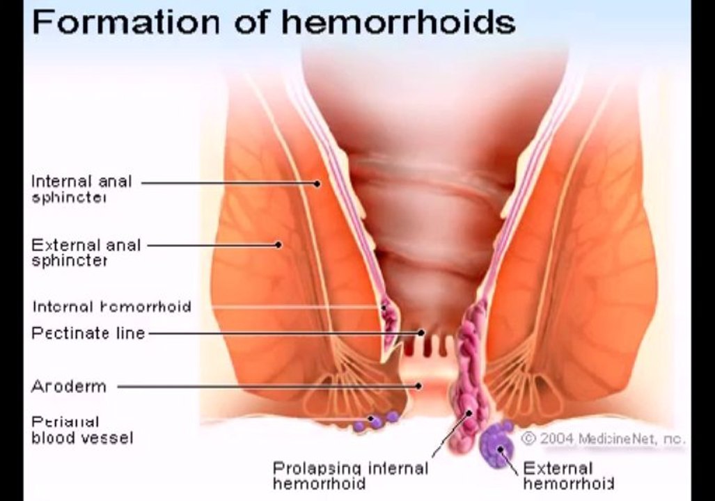 Hemorrhoid No More
