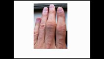 Paddison Program For Rheumatoid Arthritis Review -- Is it Legit or Scam?