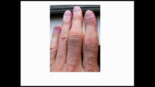 Paddison Program For Rheumatoid Arthritis Review Is it Legit or Scam?