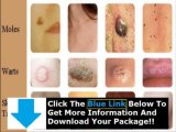 Does Moles Warts & Skin Tags Removal Really Work + Moles Warts And Skin Tags