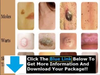 Moleswartsremoval com + Moles Warts Skin Tags Removal Ebook