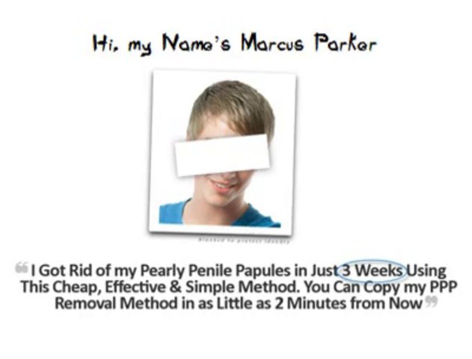 Pearly Penile Papules Removal Review