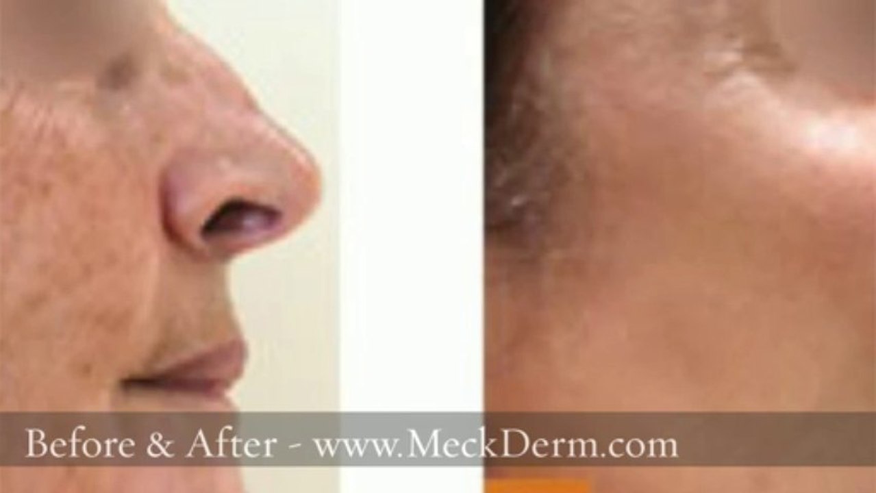 Treatment for Sun Damaged Skin Charlotte NC 704-344-8846