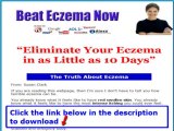 How To Beat Eczema   Beat Eczema Now