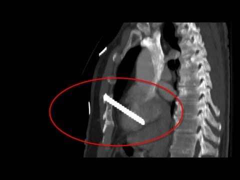 Carpenter Eugene Rakow shoots himself in heart with nail gun