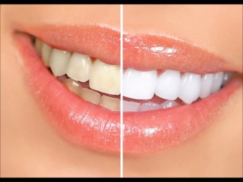 comment avoir des dents blanches avec un produit naturelle