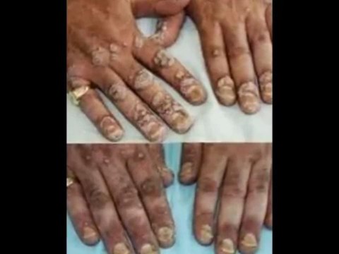 Candida Crusher - Permanent Yeast Infection Solution By Dr Eric Bakker