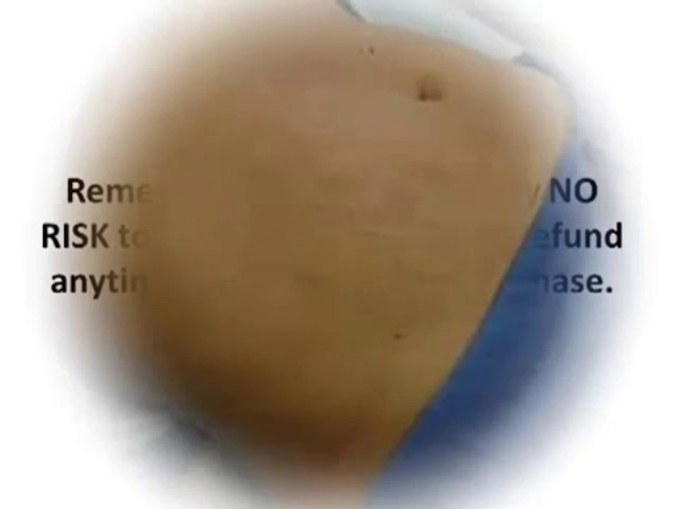 Reverse Stretch Marks for Permanent Stretch Mark Removal
