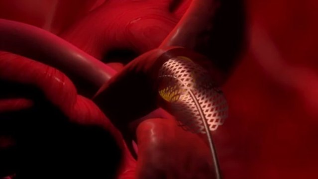 Infarto de miocardio