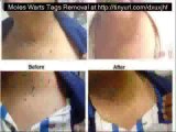 Moles Warts Skin Tags Removal Natural