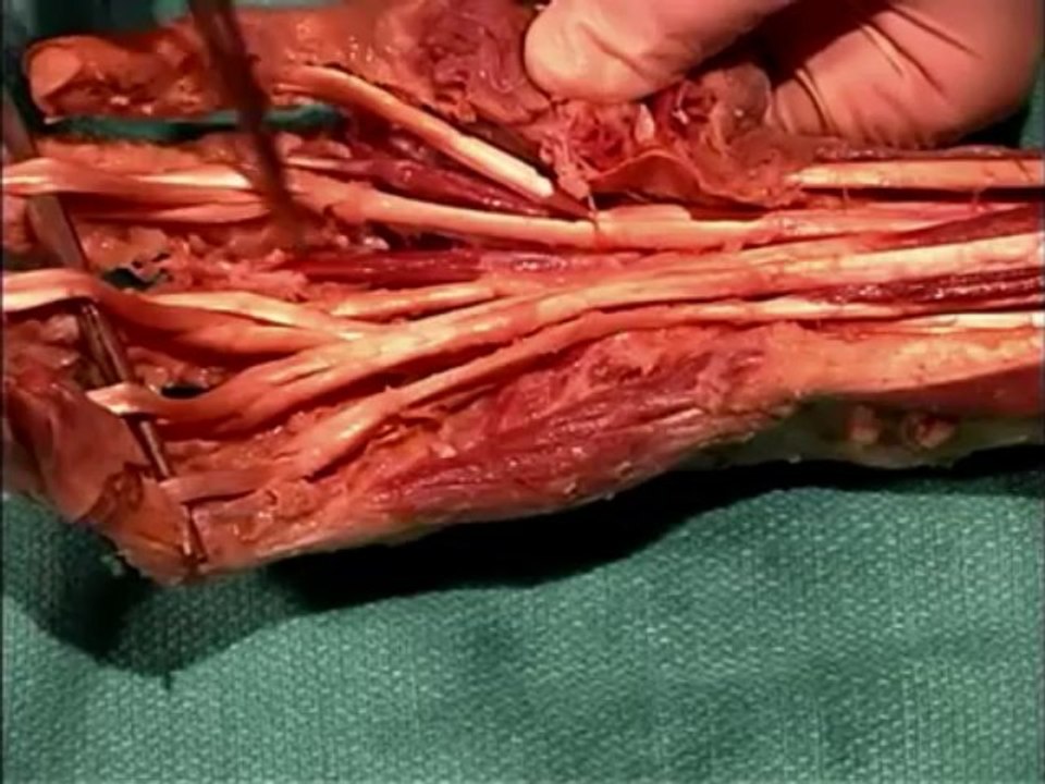 Human Anatomy Dissection 23 (part 2 of 2) Forearm and Hand
