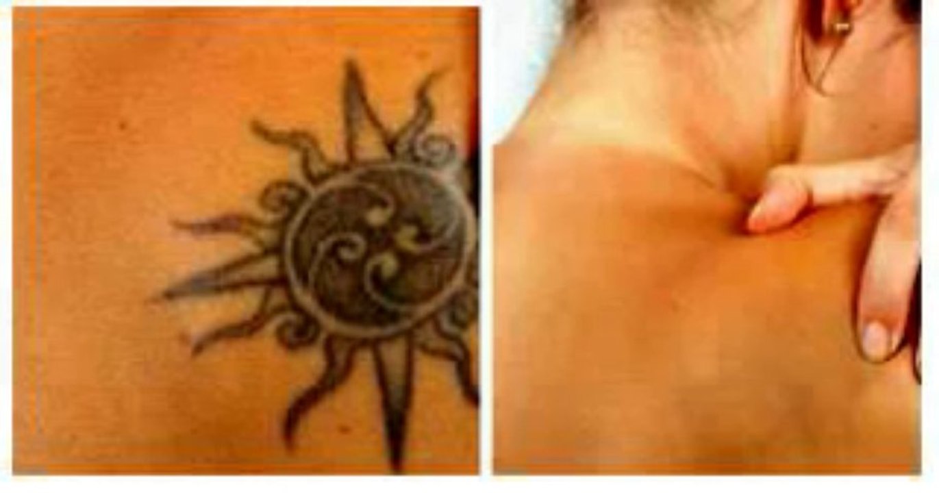 Get Rid Tattoo Review + Bonus
