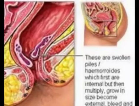 Traitements Hemorroides | Hemorroides Traitement