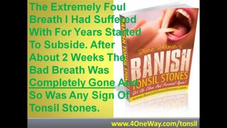 Getting Rid Of Tonsil Stones | Banish Tonsil Stones