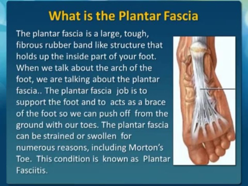 Plantar Fasciitis explained by Podiatrist of  Panama City FL