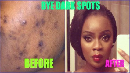 Dark Spots Be Gone | Treating ACNE scars + GIVEAWAY