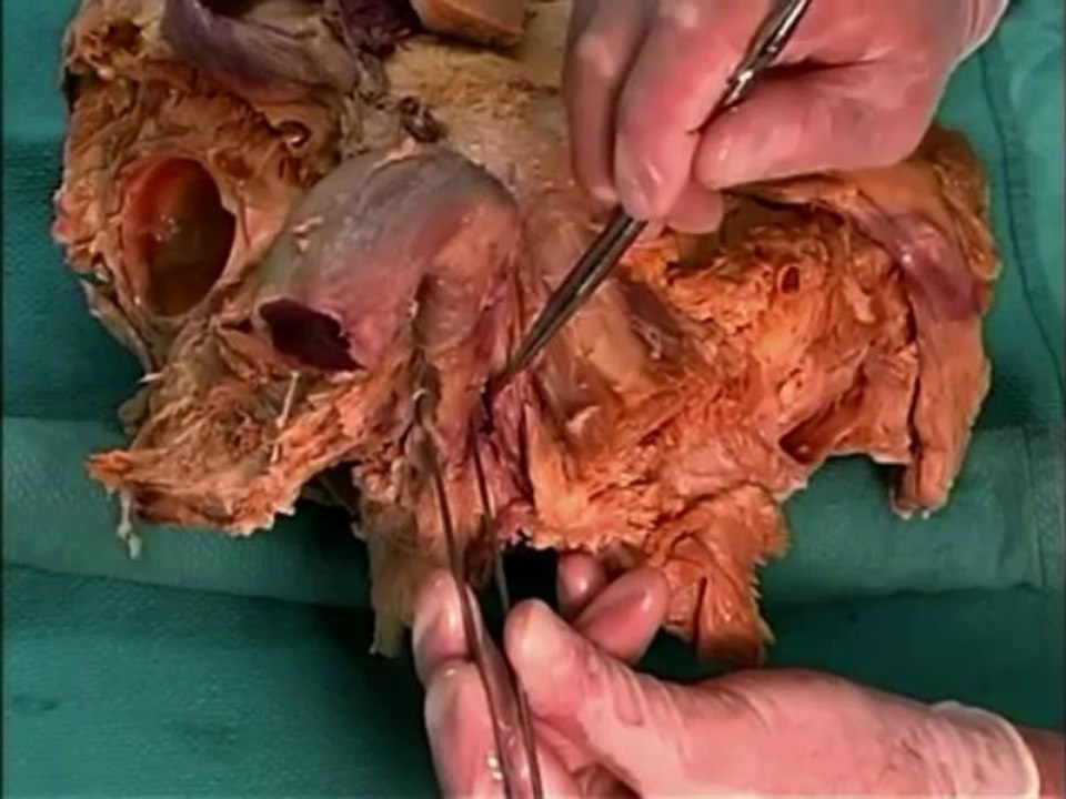 Human Anatomy Dissection 10 (part 1 of 2) Pelvic Outlet
