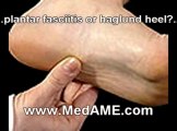 Contracture Shoe Inserts for Plantar Fasciitis Relief