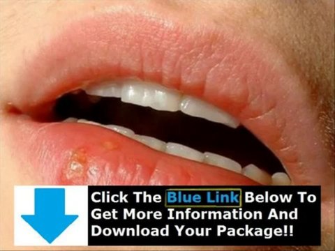 How To Get Rid Of Herpes Quickly + Get Rid Of Herpes Forever
