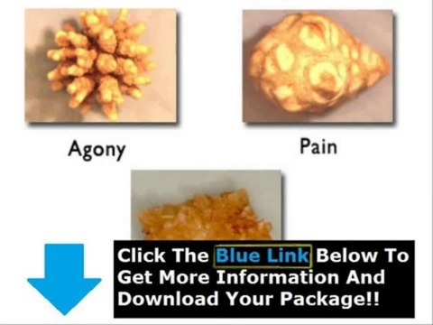 Coca Cola Kidney Stone Remedy + Kidney Stone Home Remedy Brew