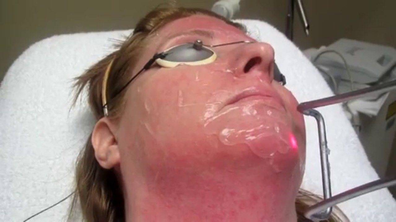 Rosacea Treatment With Laser-Los Angeles-Pasadena-Burbank-Anaheim-Long Beach-Sherman Oak