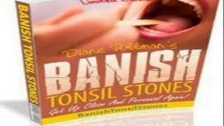 Banish Tonsil Stones Review - Banish Tonsil Stones PDF