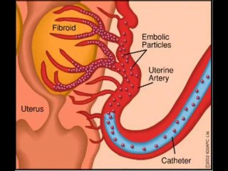 Treatment of Uterine Fibroids...Fibroids Miracle Review Natural Treatment Effective In Hours.