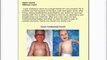 Eczema Free Forever  Review  - How to Cure Eczema Easily, Naturally and Forever