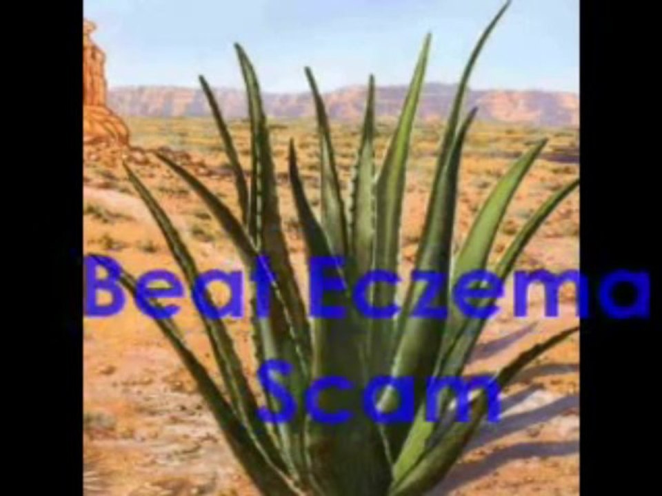 Beat Eczema Scam - Eczema in Babies