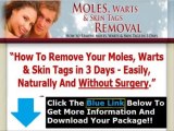 Moles Warts & Skin Tags Removal Pdf   Moles Warts Removal Review