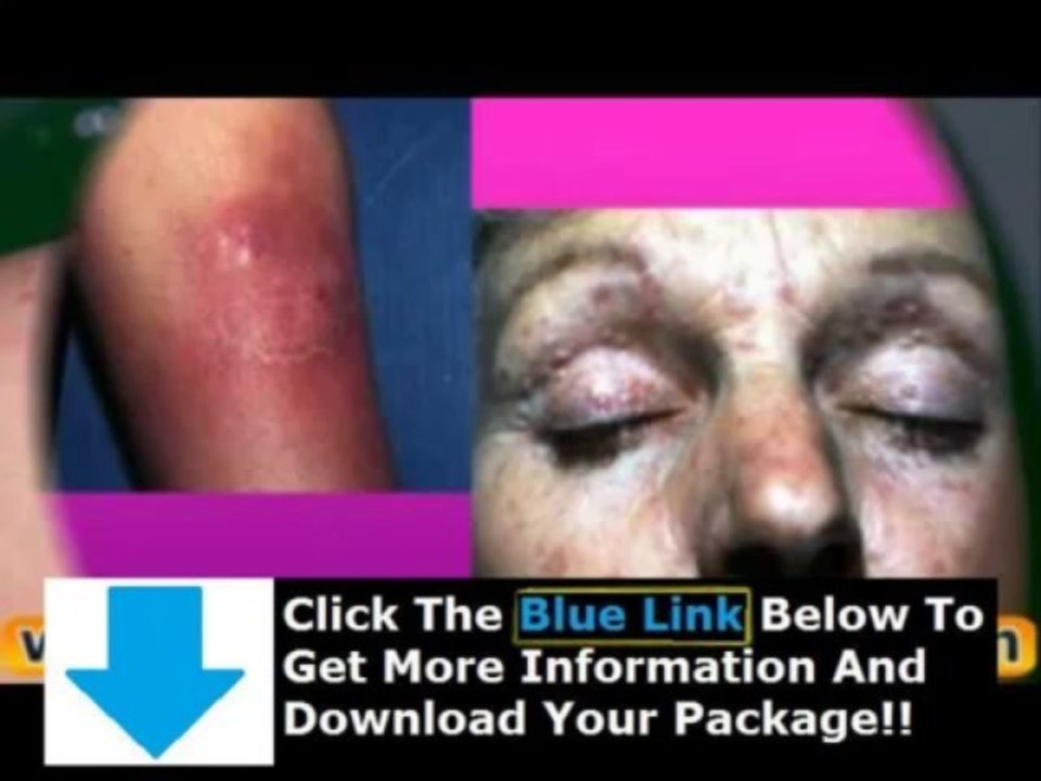 Lupus Bible + Lupus Bible Norton Protocol