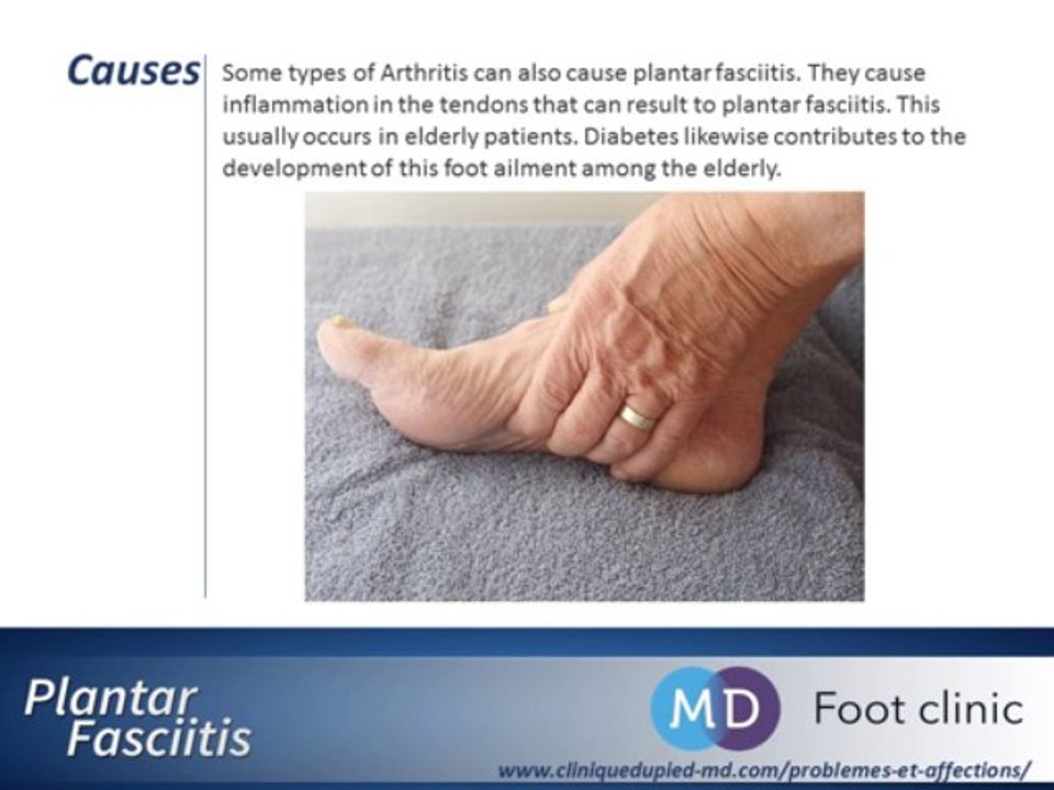 Plantar Fasciitis : Origin, Causes, Examination, Treatment of plantar fasciitis